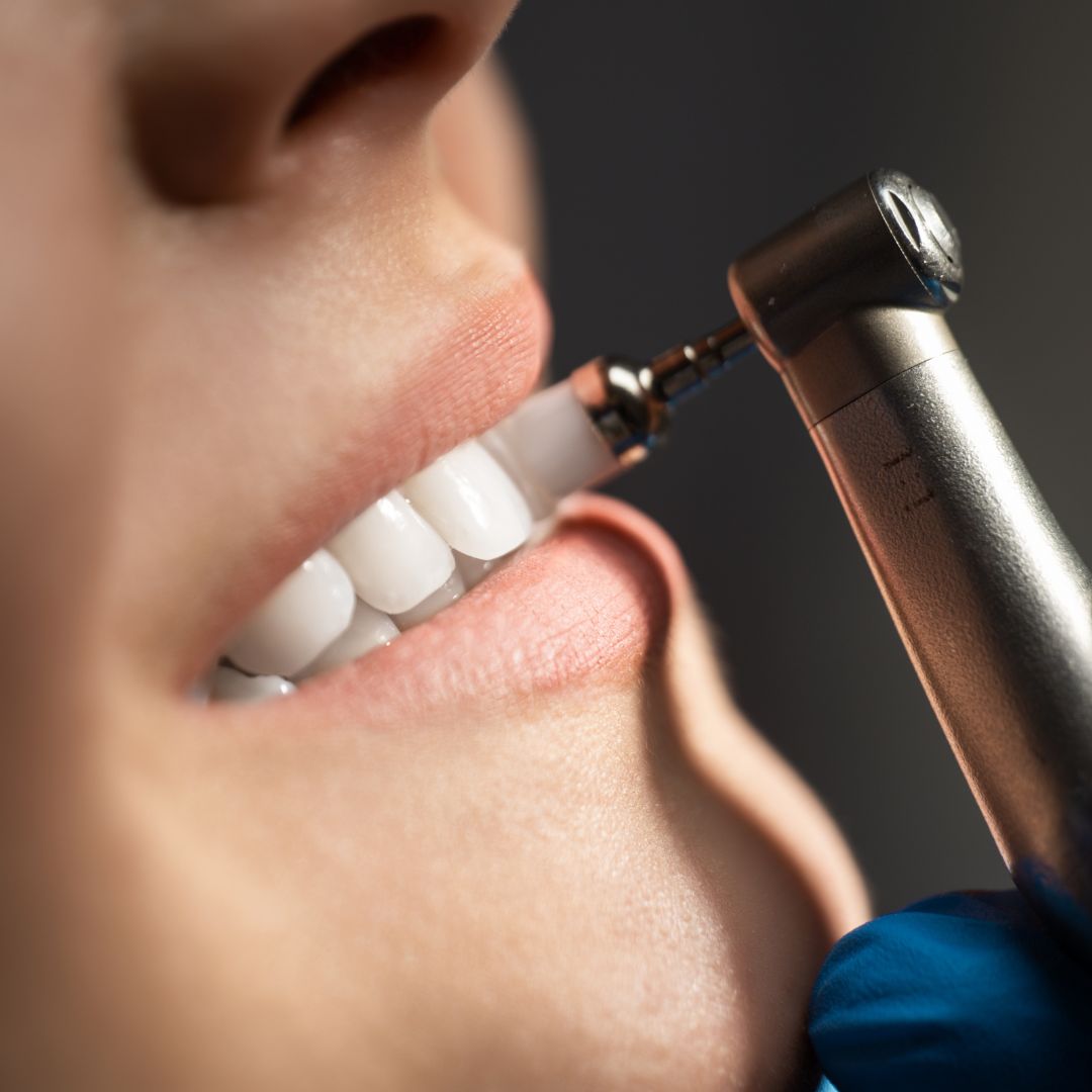 A limpeza dentária, também conhecida por profilaxia dental, destaca-se como um pilar fundamental para a manutenção da higiene e saúde da nossa boca.