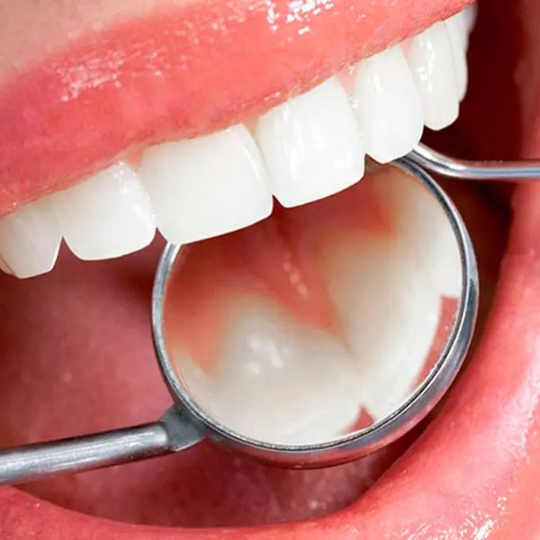 Periodontite e Gengivite: Compreendendo os Tratamentos.
