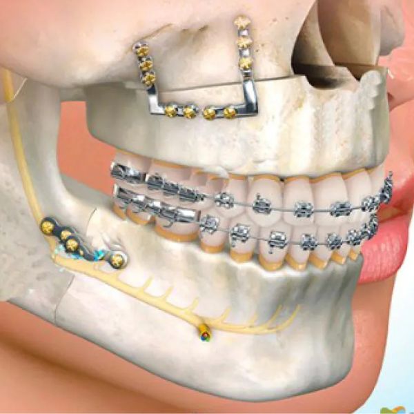 Os Benefícios da Cirurgia Ortognática Para a Saúde Bucal e Estética Facial.