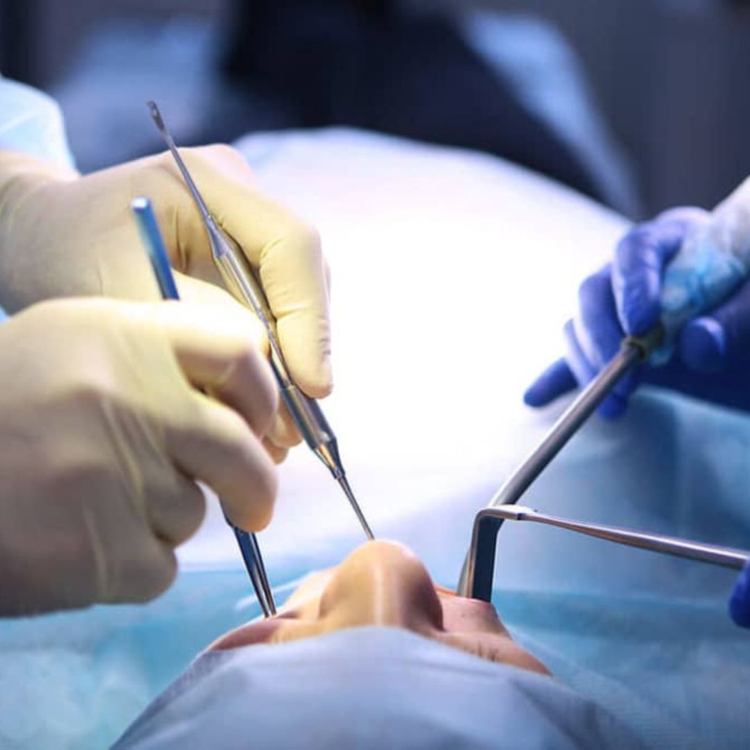 O enxerto ósseo se refere ao transplante de tecido ósseo para reconstruir ou aumentar o volume do osso em áreas onde houve perda óssea.