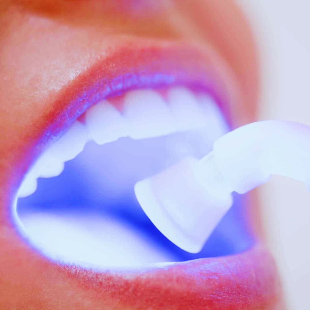 O clareamento dental se tornou uma solução popular para aqueles que desejam alcançar dentes mais claros e radiantes.
