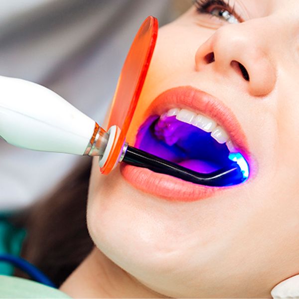 O Guia Completo Sobre Clareamento Dental Para Um Sorriso Mais Branco.