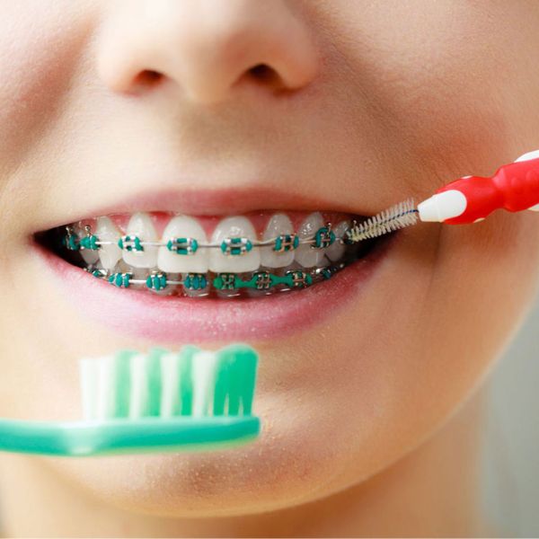 Dicas para Manter a Higiene Oral com Aparelho Ortodôntico.