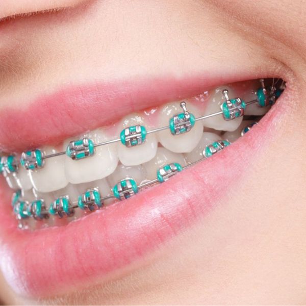 Dicas para Manter a Higiene Oral com Aparelho Ortodôntico.