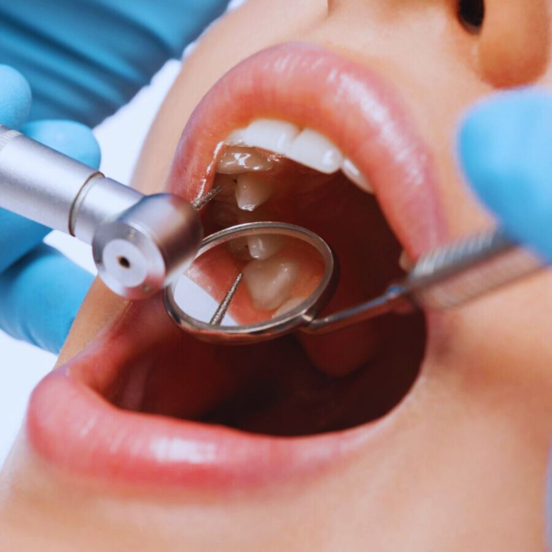 O tratamento de canal é bastante comum e realizado frequentemente em consultórios dentários.