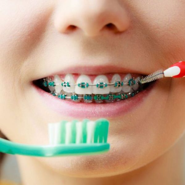 Escova Ortodôntica ou Escova Interdental: Qual a Melhor Opção?