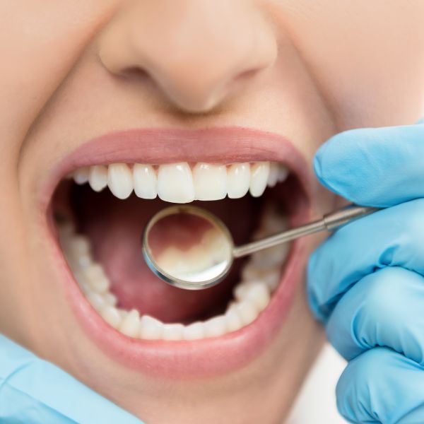 Como o Biofilme Dental Afeta a Saúde Bucal e Como Evitá-lo.