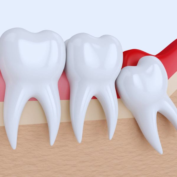 Dentes do Siso: Quando Extrair e Quando Manter?