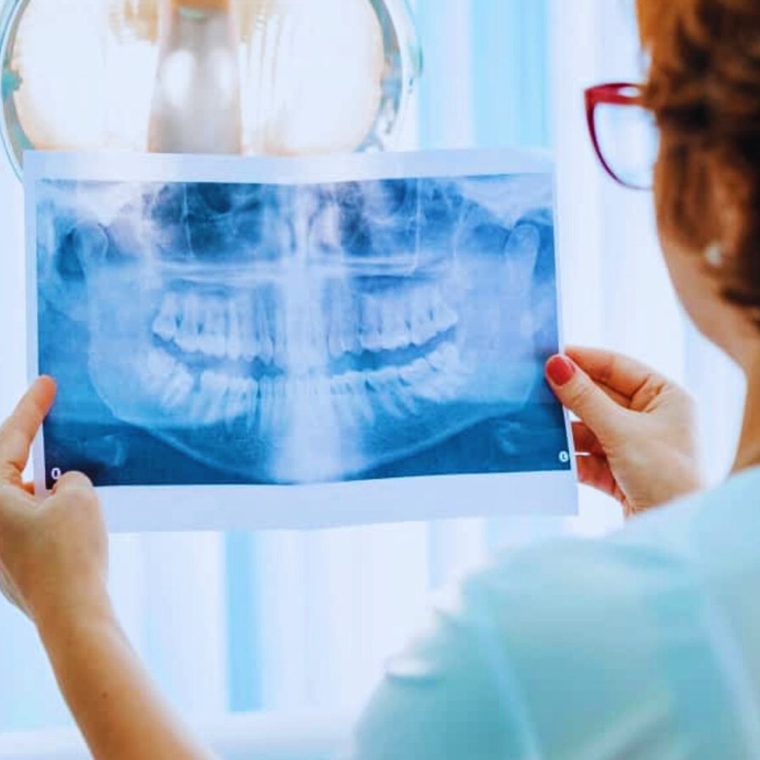 A prevenção da perda óssea dentária começa com uma higiene bucal adequada.