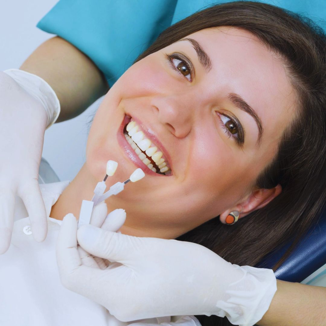 As lentes de contato dental se tornaram uma solução popular para corrigir imperfeições como descoloração e desalinhamento.