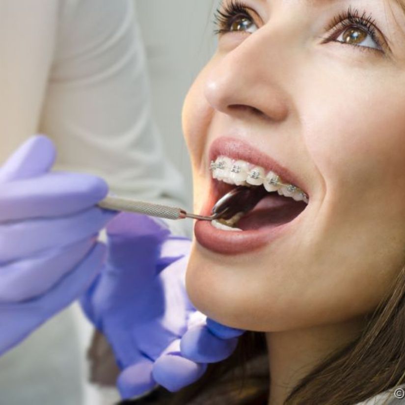 Aparelhos Ortodônticos: Qual a Melhor Opção para Adultos?