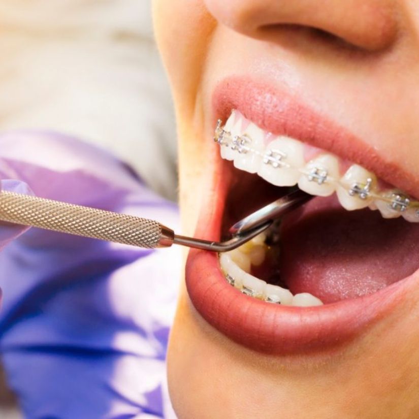 Aparelhos Ortodônticos: Qual a Melhor Opção para Adultos?