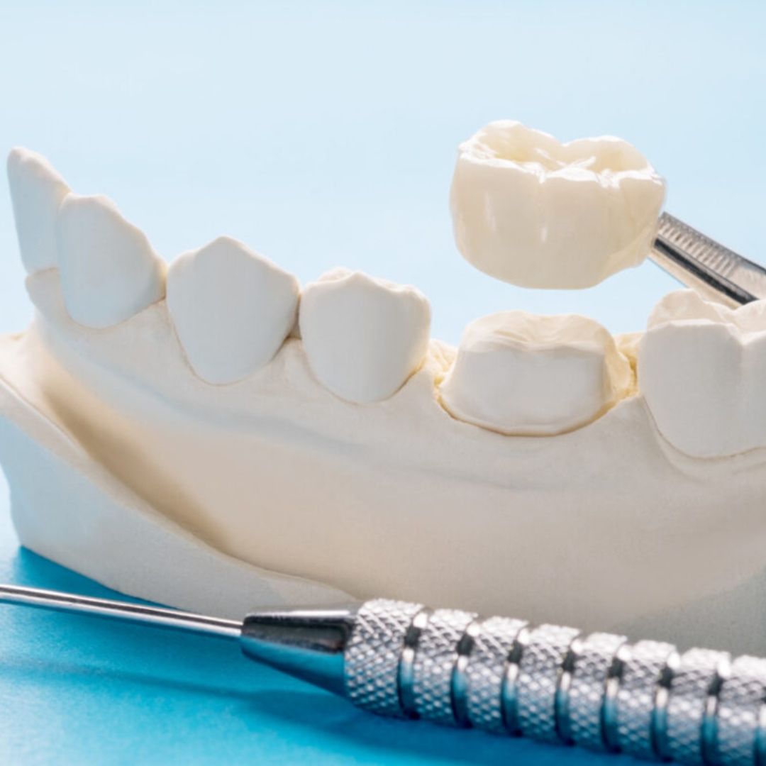 As coroas de porcelana desempenham um papel crucial ao proporcionar um sorriso mais natural e harmonioso.