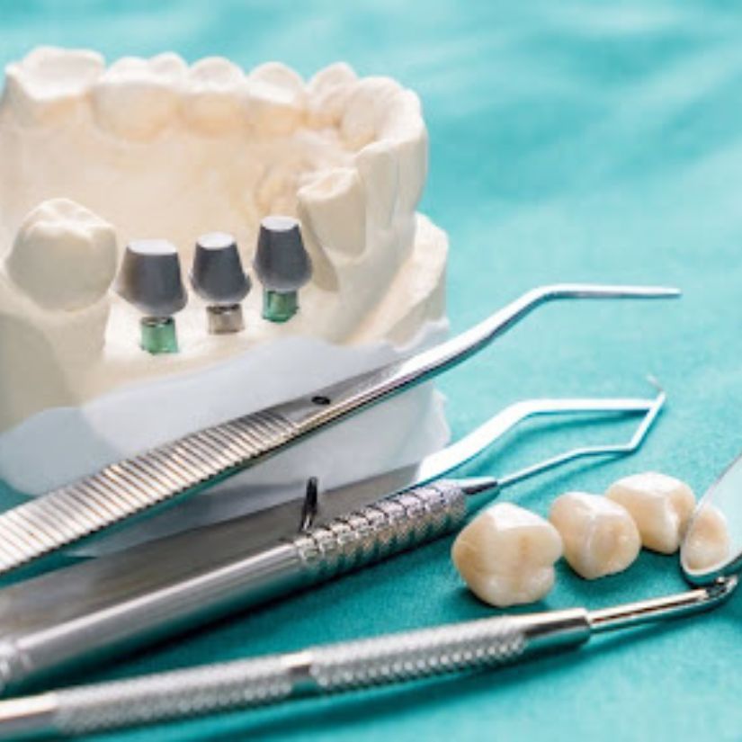 As Vantagens das Coroas de Porcelana na Odontologia Estética.