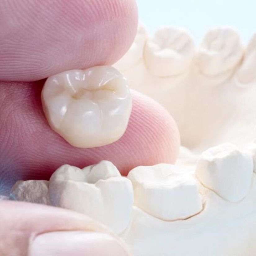 As Vantagens das Coroas de Porcelana na Odontologia Estética.