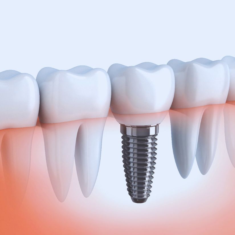 Estética e Funcionalidade dos Implantes Unitários na Odontologia.
