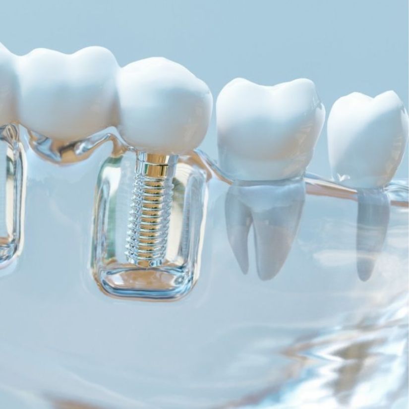 Estética e Funcionalidade dos Implantes Unitários na Odontologia.