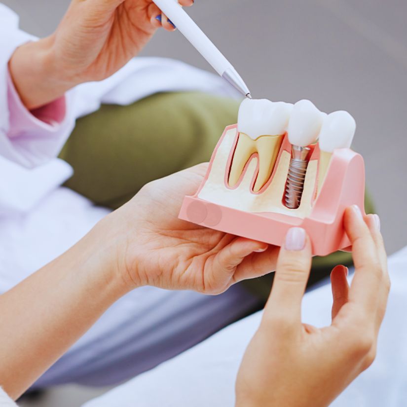 Como a Tecnologia está Revolucionando os Implantes Dentários.