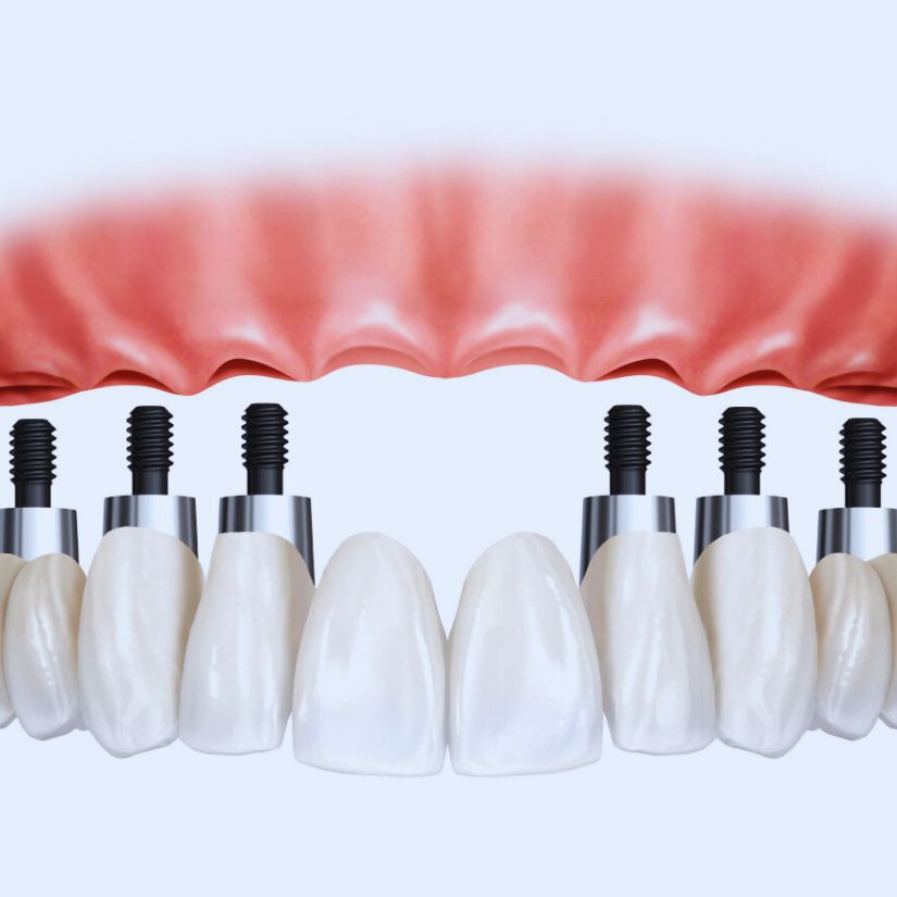 Como a Tecnologia está Revolucionando os Implantes Dentários.