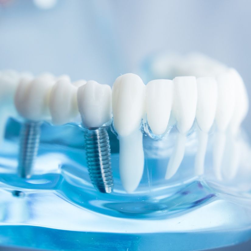 Prótese Overdenture como Solução para a Perda Dentária.
