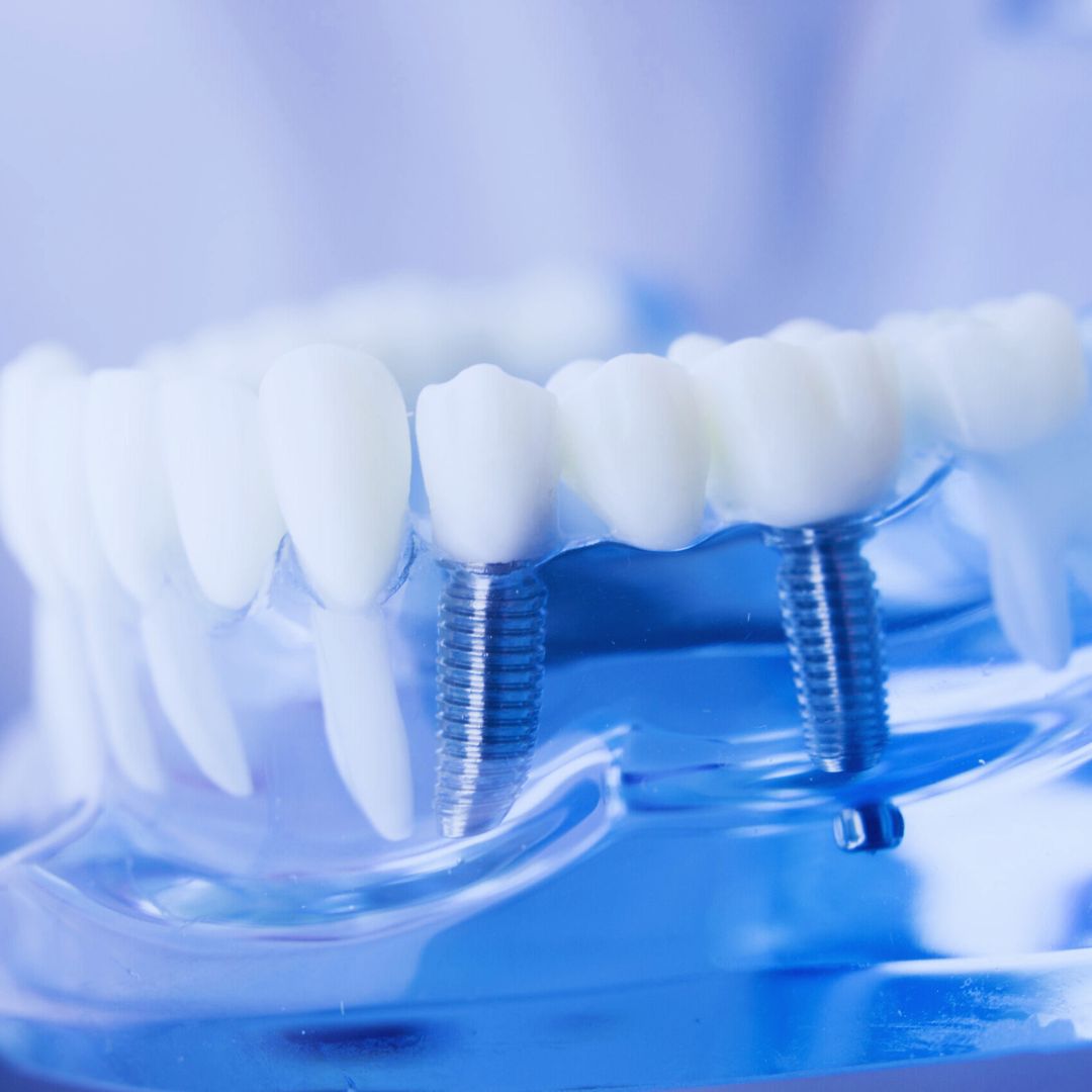 Os implantes dentários servem como uma base sólida para coroas, pontes ou próteses completas.