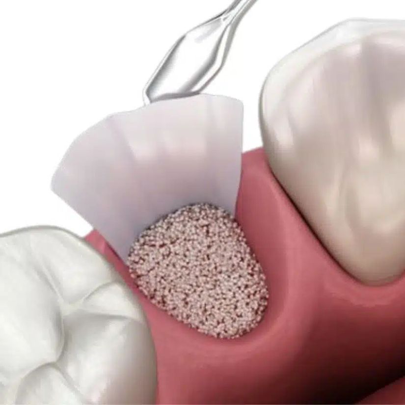 Por Que o Enxerto Ósseo é Essencial para o Sucesso dos Implantes.