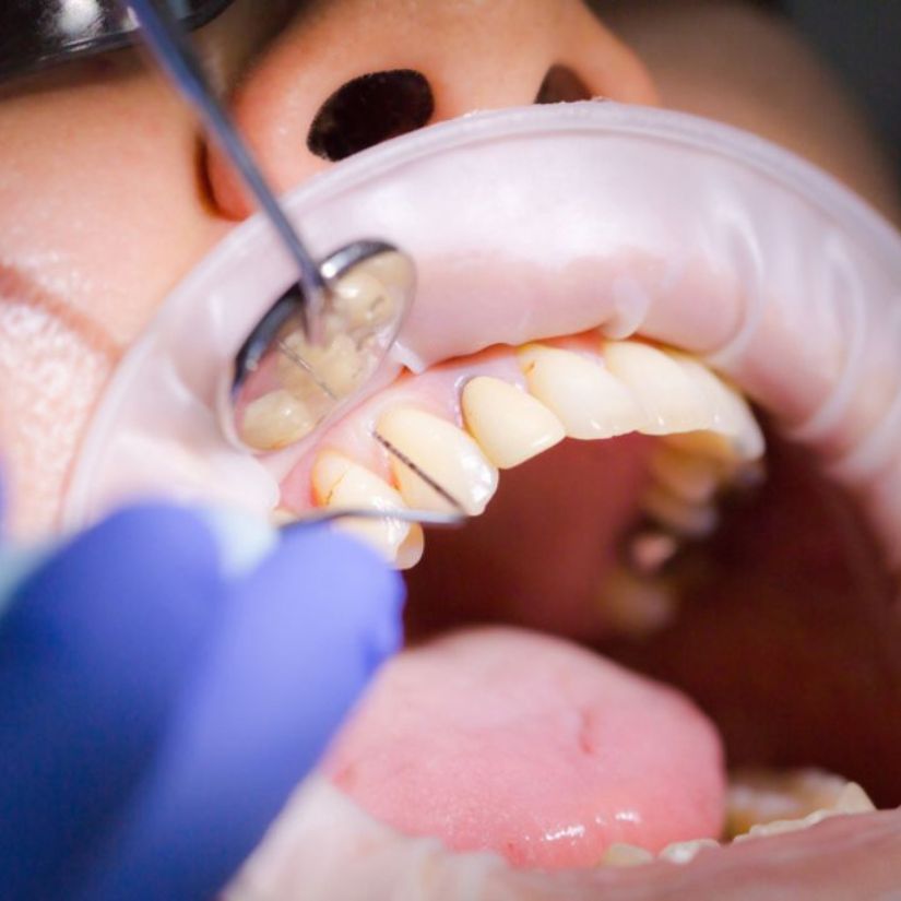 Entenda a Importância da Periodontia para a Saúde Bucal.