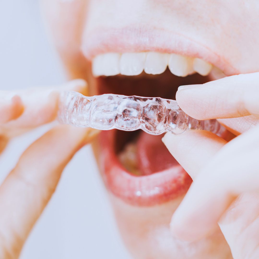 Diferentemente dos aparelhos tradicionais, ele utiliza alinhadores transparentes, tornando-se uma opção quase invisível para o alinhamento dental.