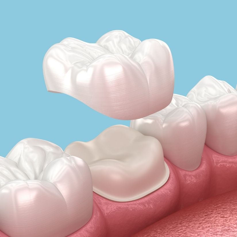 Coroas em Porcelana como Solução Estética e Funcional.