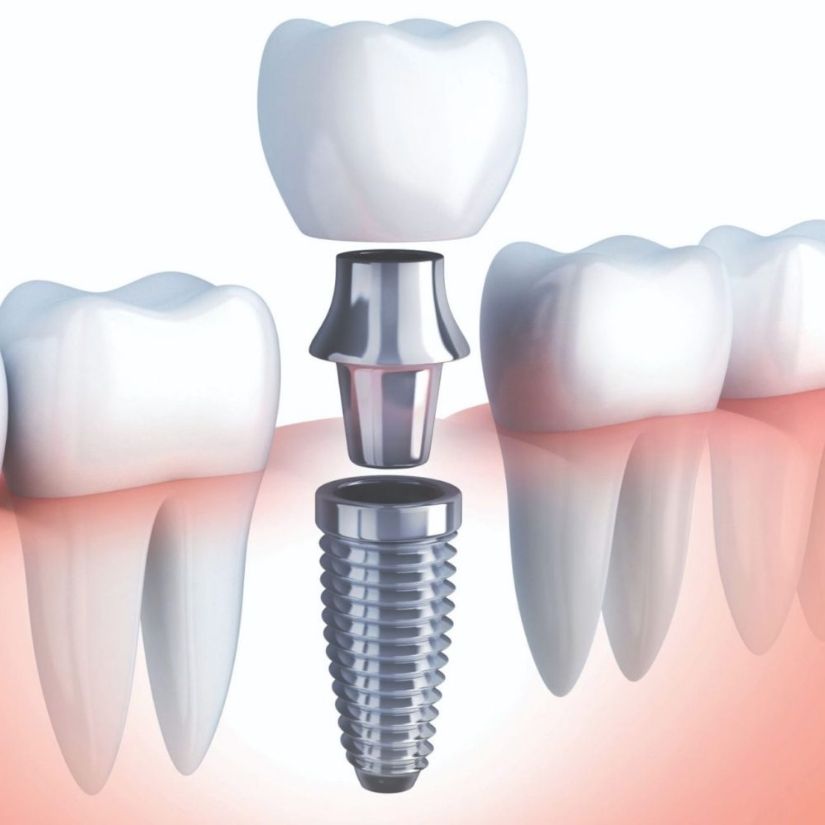Implantes Unitários como Solução Odontológica para a Perda de Um Dente.