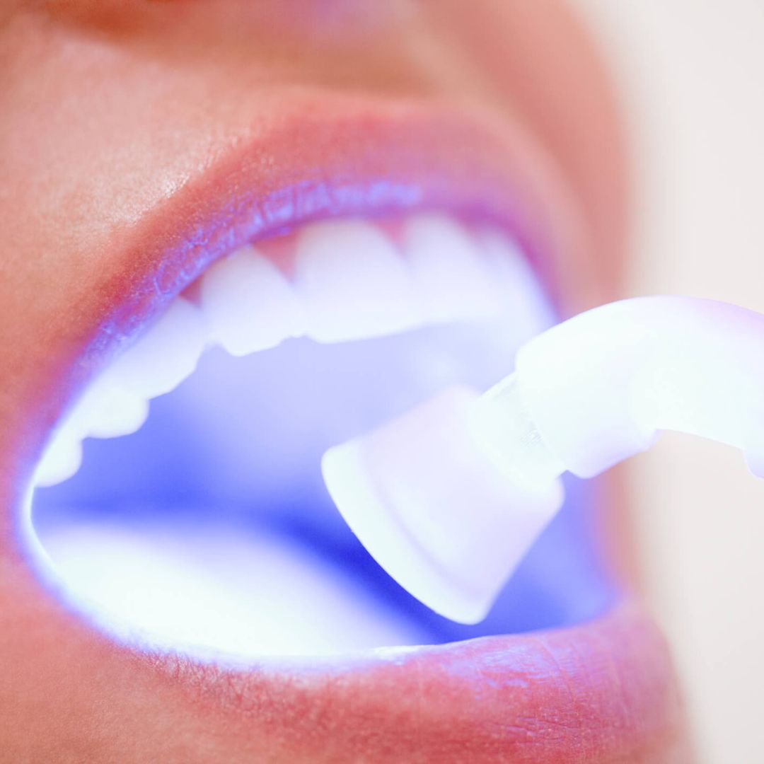 O clareamento dental é um procedimento estético que visa a remoção de manchas e pigmentos, resultando em dentes mais brancos.