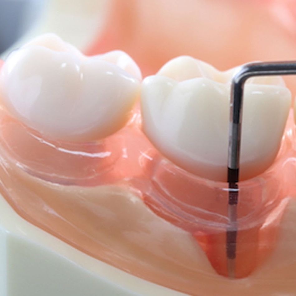 Tratamento Periodontal e a Importância da Saúde Gengival.