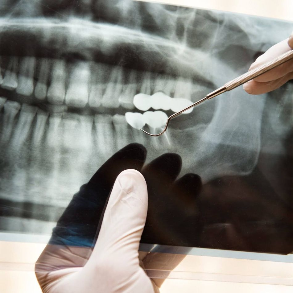 Tipos de Enxerto Ósseo e suas Indicações na Odontologia.