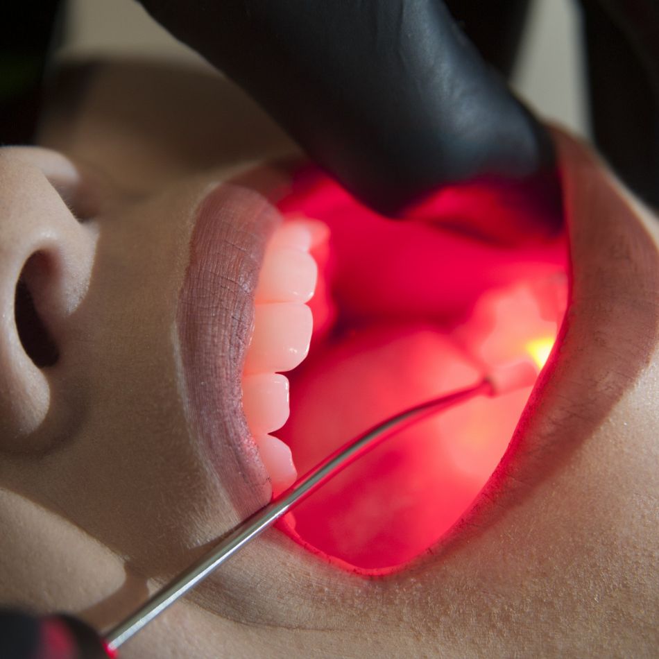 Vantagens da Laserterapia na Periodontia.