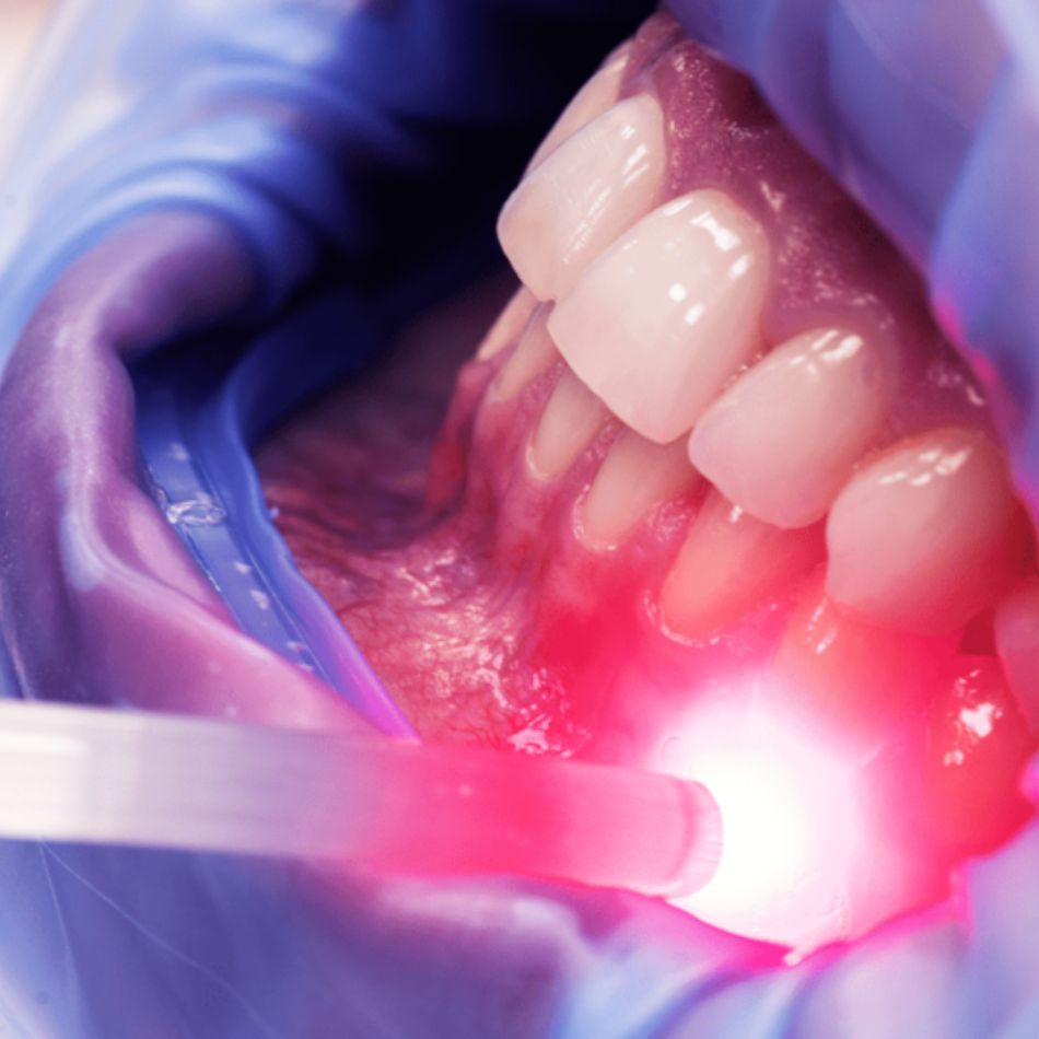Vantagens da Laserterapia na Periodontia.