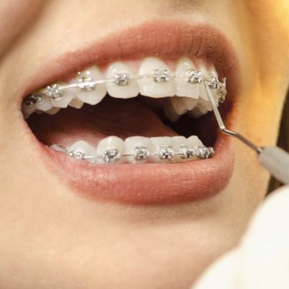 Ortodontia Estética Para Adultos: Tratamentos Modernos e Eficazes.