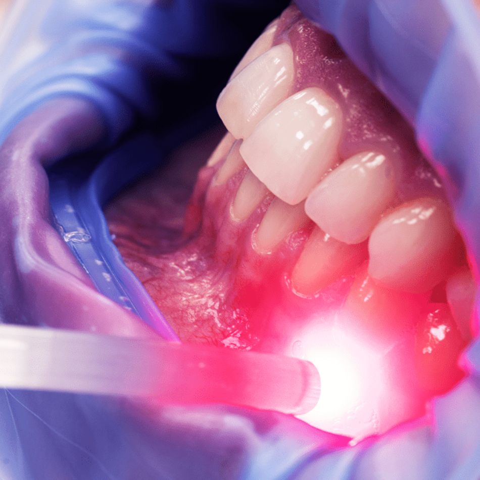 Laser em Tratamentos Gengivais e Seus Benefícios Inquestionáveis.