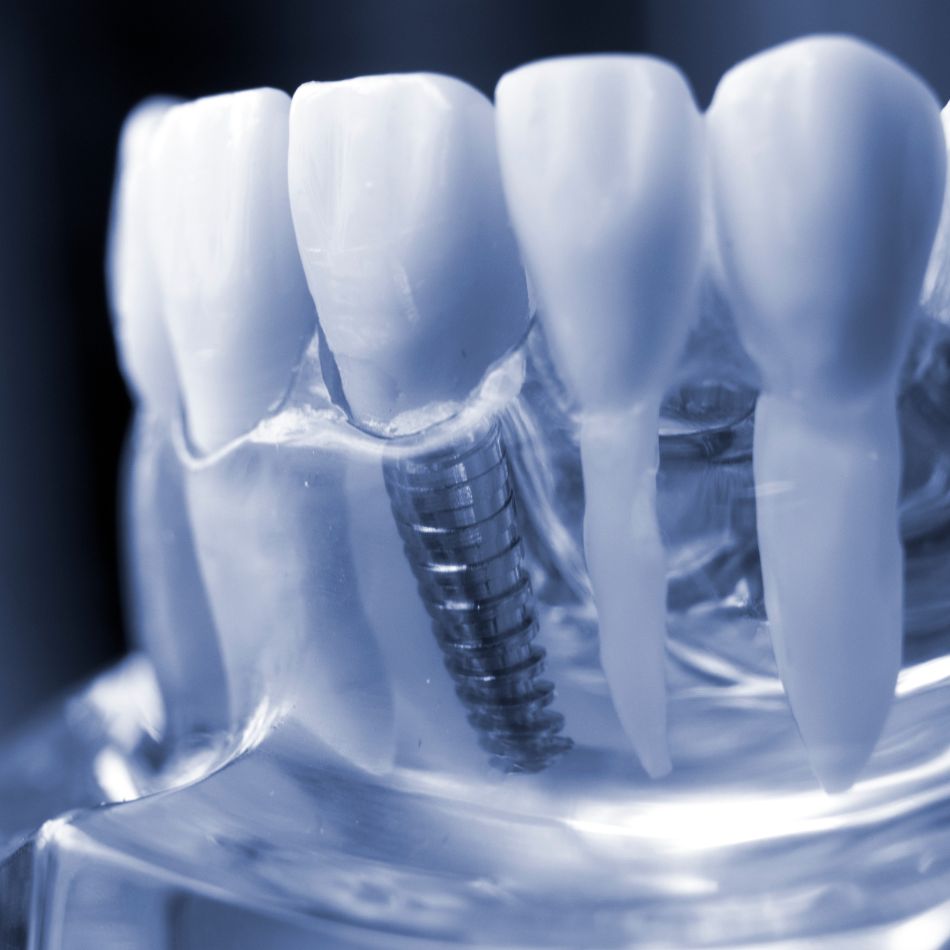 Implantes Dentários: Dentes Fixos, Mastigação Forte e Sorriso Perfeito.