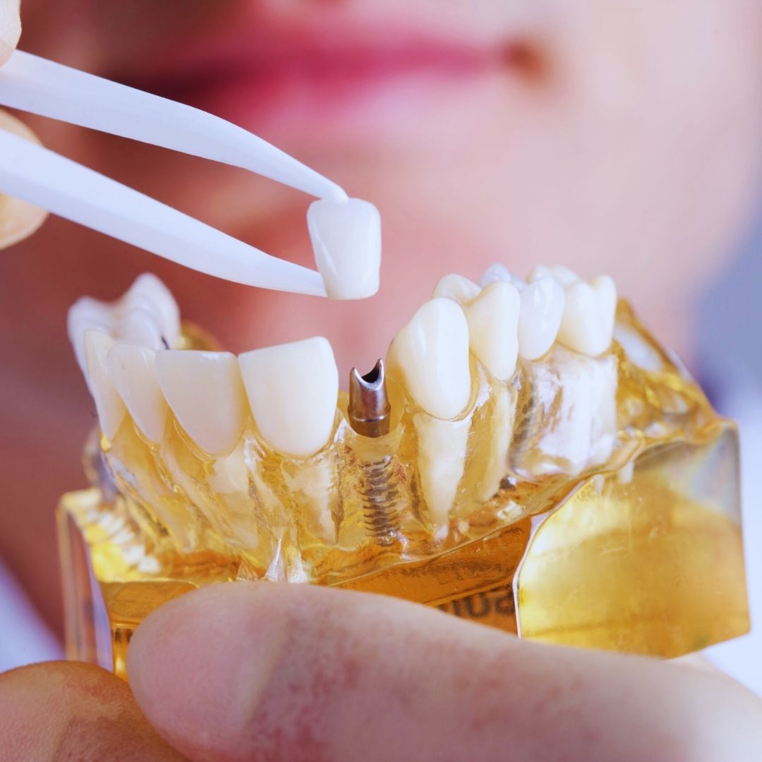 Você concorda que a ideia de passar meses com uma falha aparente no sorriso gera vergonha ao conversar ou trabalhar? A odontologia moderna permite colocar o dente logo após a cirurgia com conforto e segurança biológica.